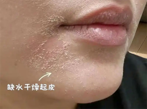 脸部脱皮干燥脱屑 脸部脱皮干燥脱屑是怎么回事?